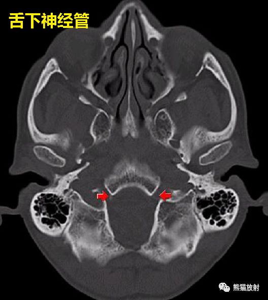 颅底孔道及内容物