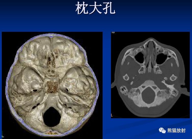 颅底孔道及内容物