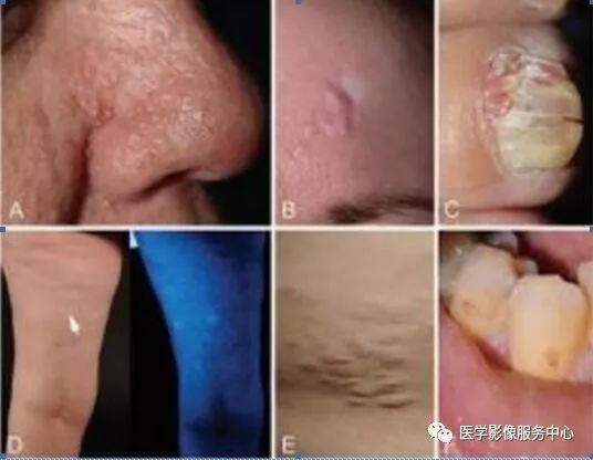 掌握这些特征,秒杀结节性硬化症 掌握这些特征,秒杀结节性硬化症