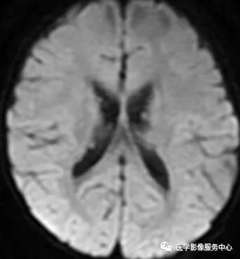 掌握这些特征,秒杀结节性硬化症 掌握这些特征,秒杀结节性硬化症
