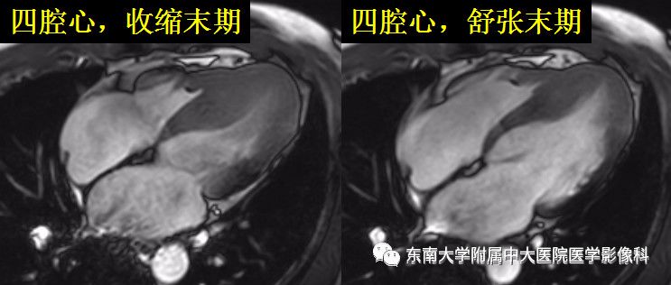 【病例】肥厚性心肌病1例MR 【病例】肥厚性心肌病1例MR
