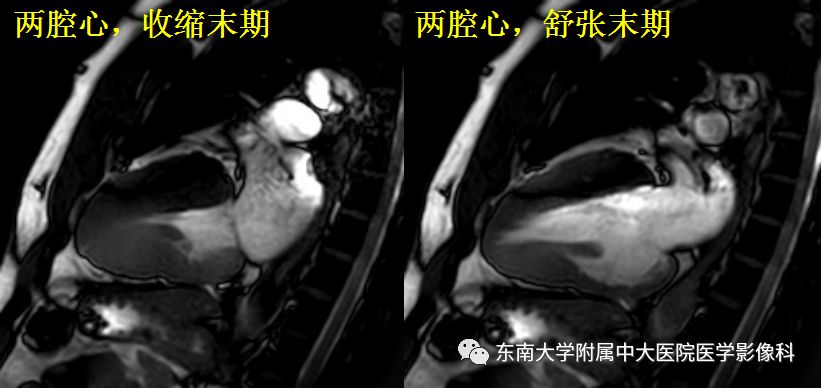 【病例】肥厚性心肌病1例MR 【病例】肥厚性心肌病1例MR