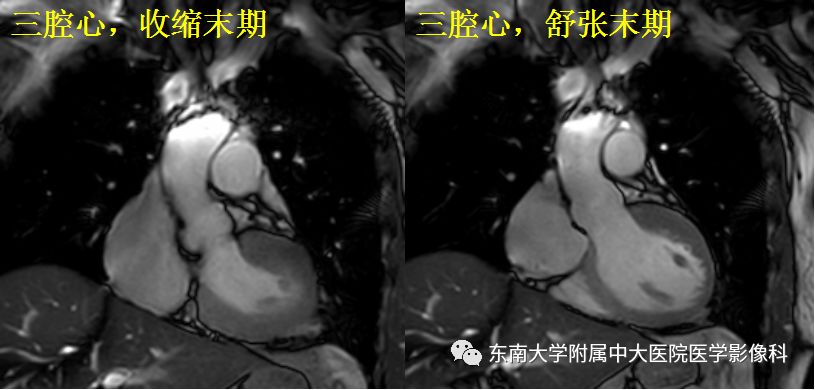 【病例】肥厚性心肌病1例MR 【病例】肥厚性心肌病1例MR