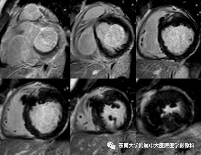 【病例】肥厚性心肌病1例MR 【病例】肥厚性心肌病1例MR