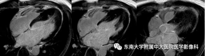 【病例】肥厚性心肌病1例MR 【病例】肥厚性心肌病1例MR
