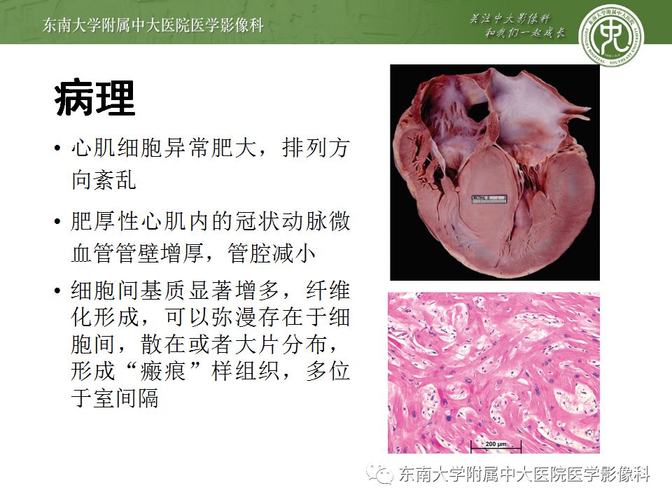 【病例】肥厚性心肌病1例MR 【病例】肥厚性心肌病1例MR
