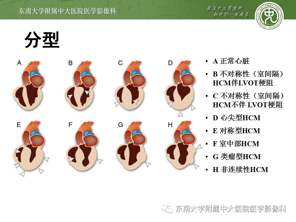 【病例】肥厚性心肌病1例MR 【病例】肥厚性心肌病1例MR