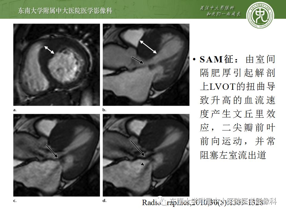 【病例】肥厚性心肌病1例MR 【病例】肥厚性心肌病1例MR