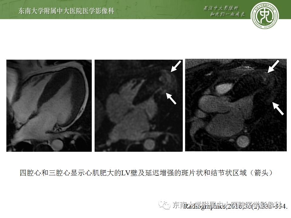 【病例】肥厚性心肌病1例MR 【病例】肥厚性心肌病1例MR
