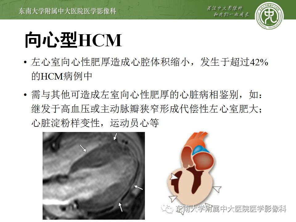 【病例】肥厚性心肌病1例MR 【病例】肥厚性心肌病1例MR