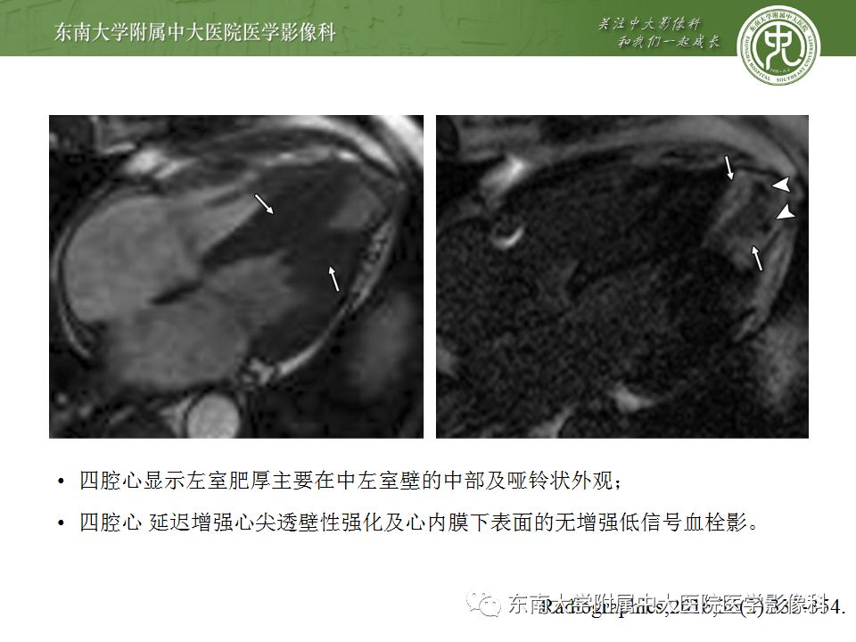 【病例】肥厚性心肌病1例MR 【病例】肥厚性心肌病1例MR