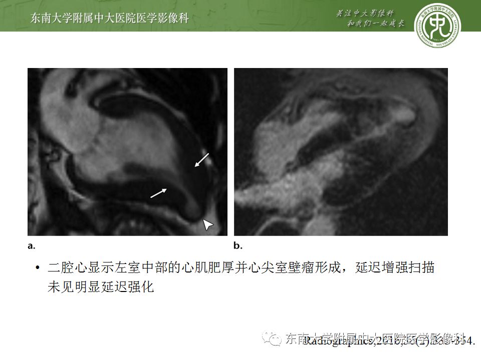 【病例】肥厚性心肌病1例MR 【病例】肥厚性心肌病1例MR