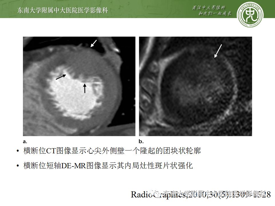 【病例】肥厚性心肌病1例MR 【病例】肥厚性心肌病1例MR