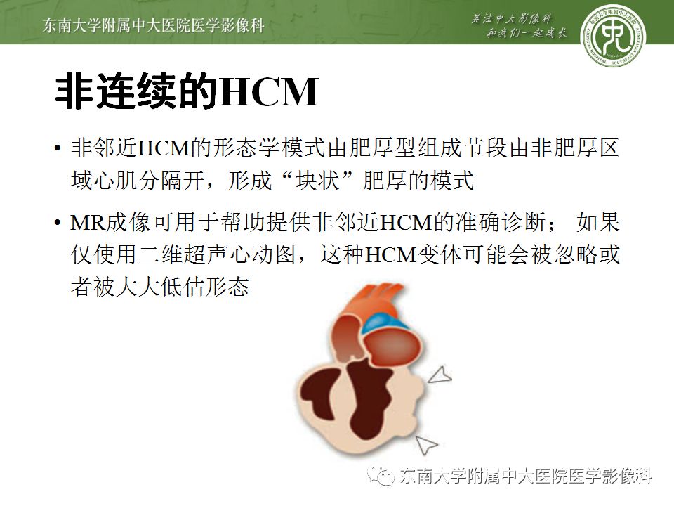 【病例】肥厚性心肌病1例MR 【病例】肥厚性心肌病1例MR