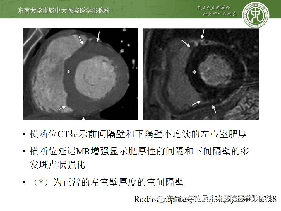 【病例】肥厚性心肌病1例MR 【病例】肥厚性心肌病1例MR