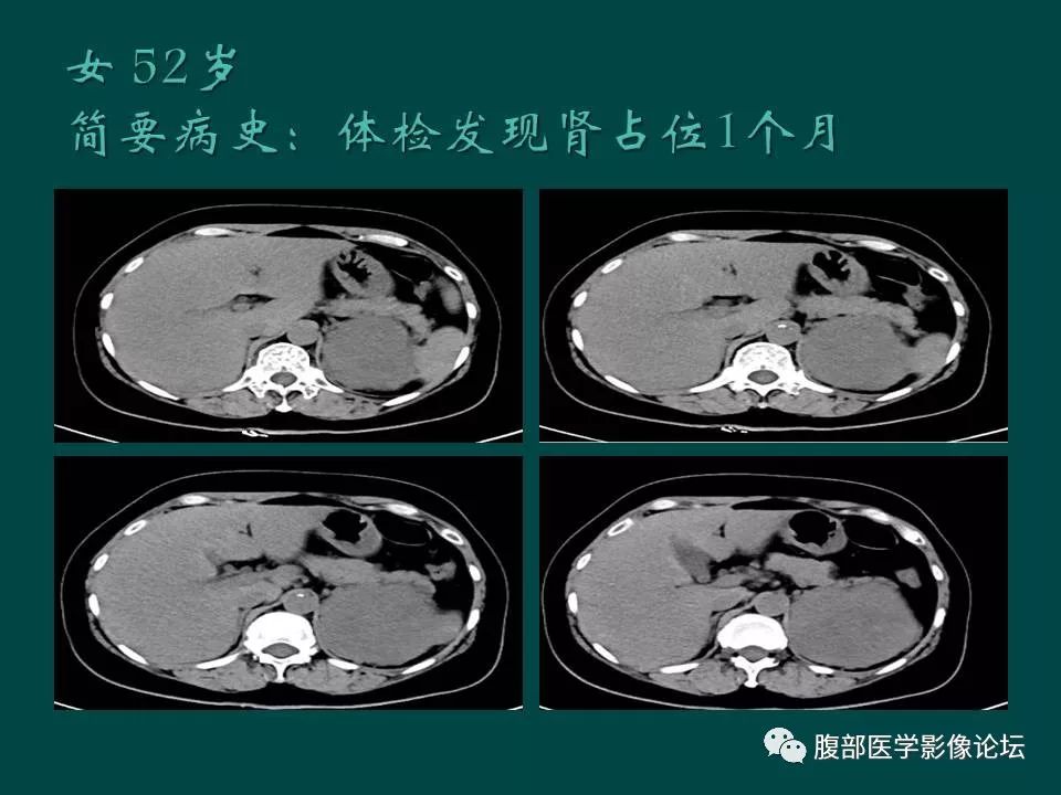 【病例】左肾嫌色细胞癌1例CT