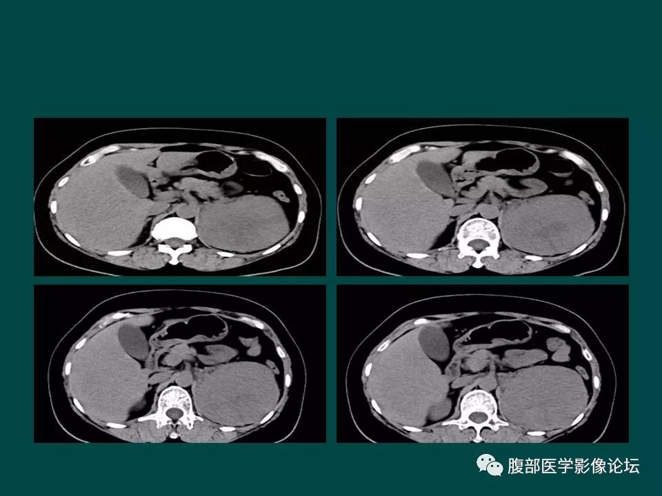 【病例】左肾嫌色细胞癌1例CT