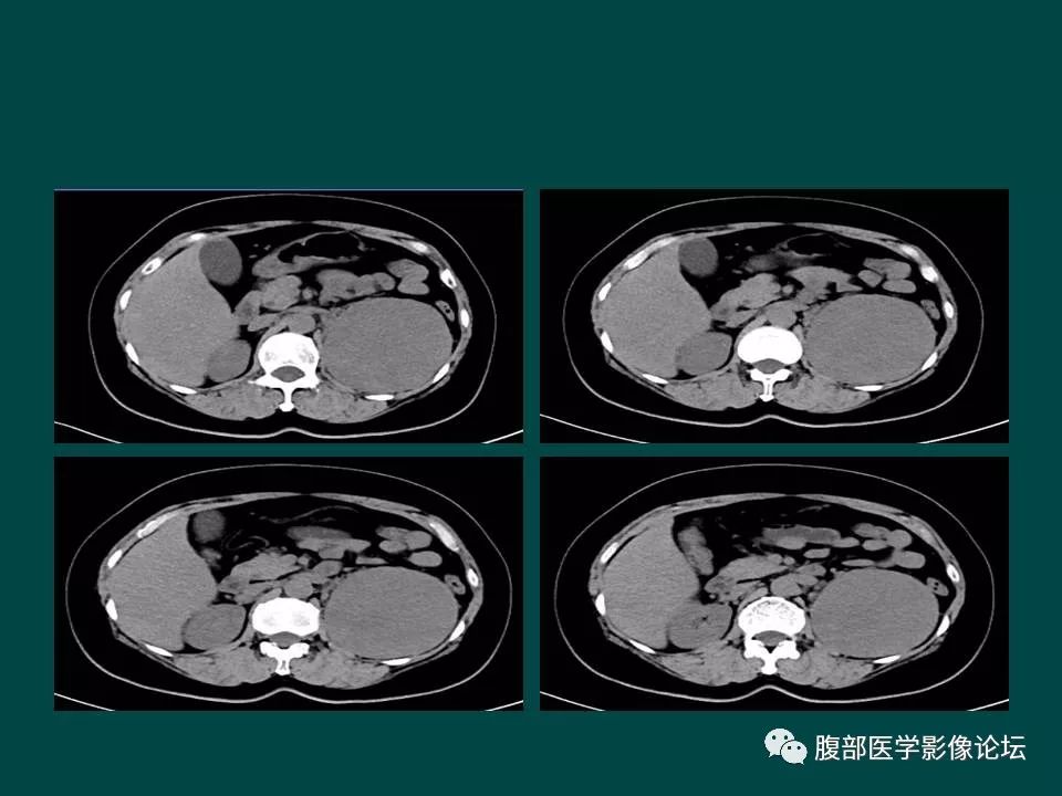 【病例】左肾嫌色细胞癌1例CT