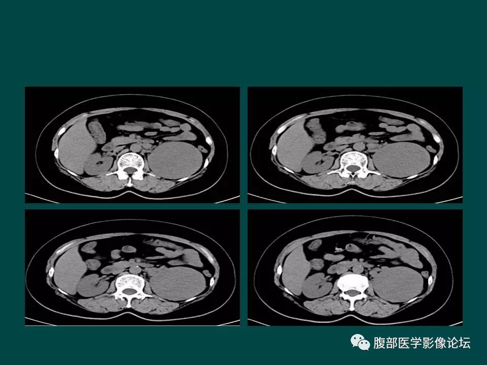 【病例】左肾嫌色细胞癌1例CT