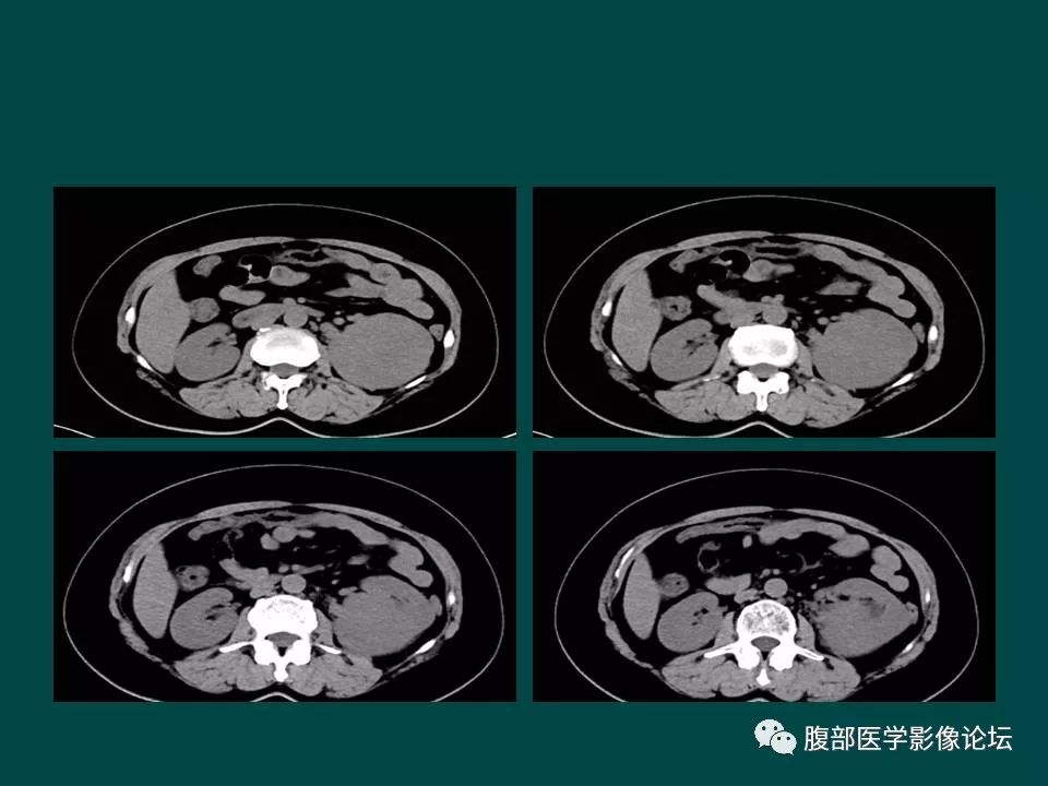 【病例】左肾嫌色细胞癌1例CT