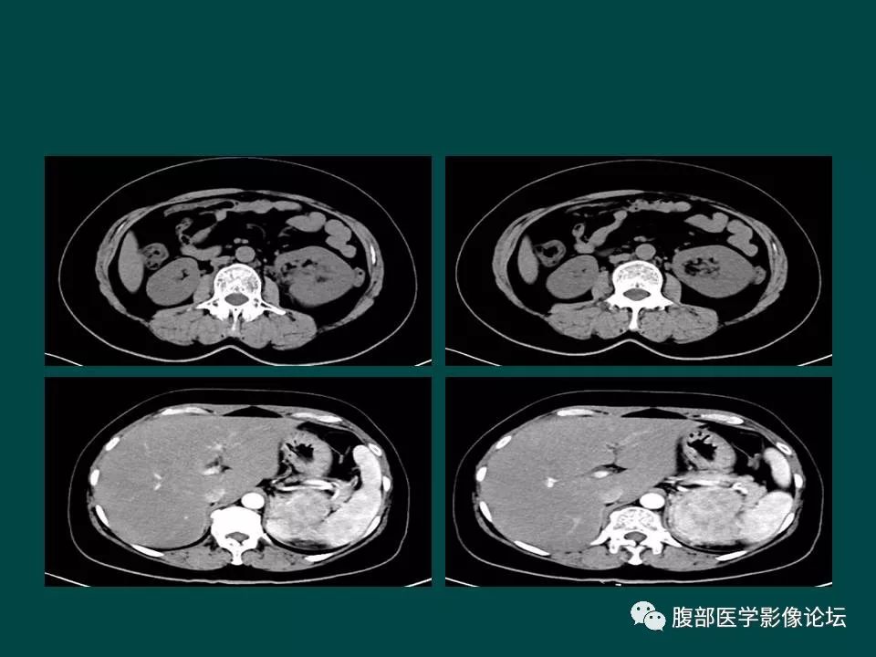 【病例】左肾嫌色细胞癌1例CT