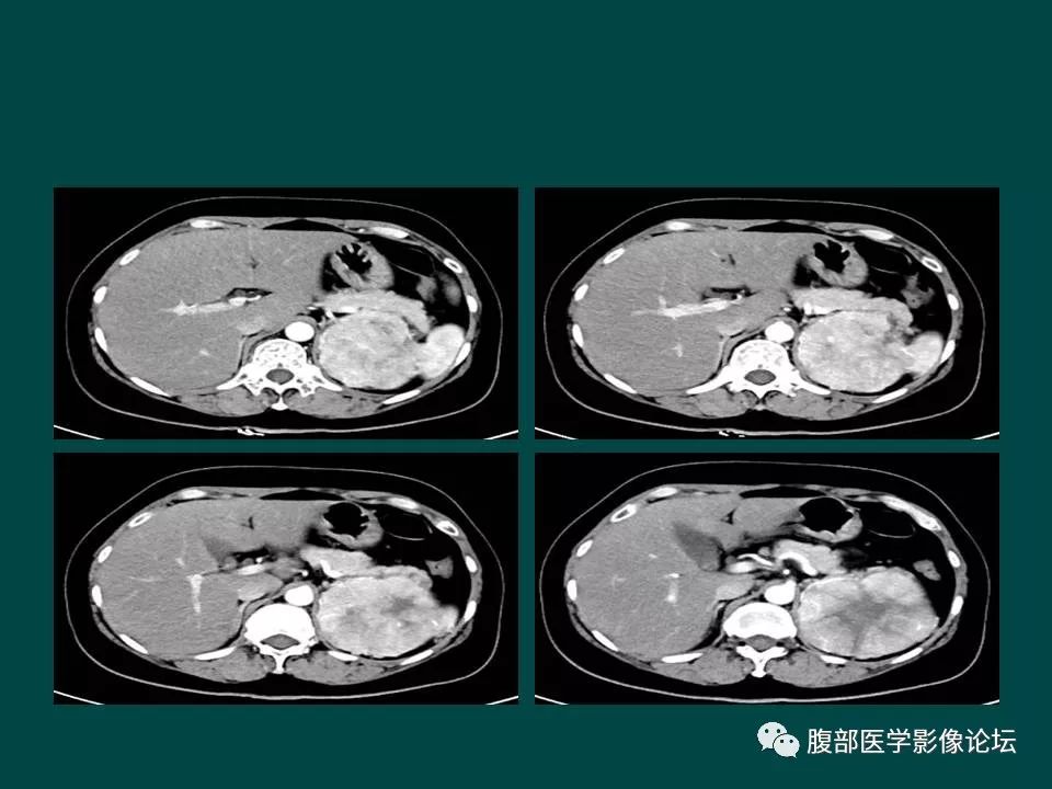 【病例】左肾嫌色细胞癌1例CT