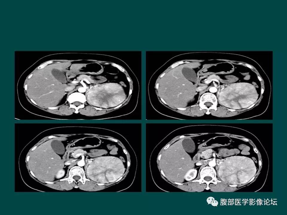 【病例】左肾嫌色细胞癌1例CT