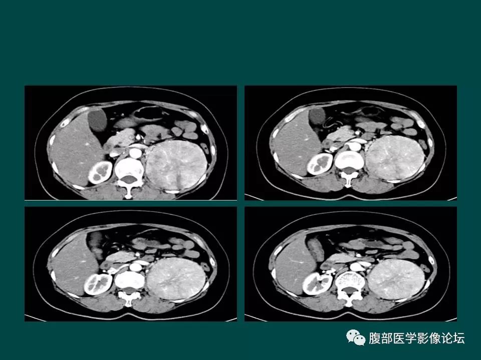 【病例】左肾嫌色细胞癌1例CT