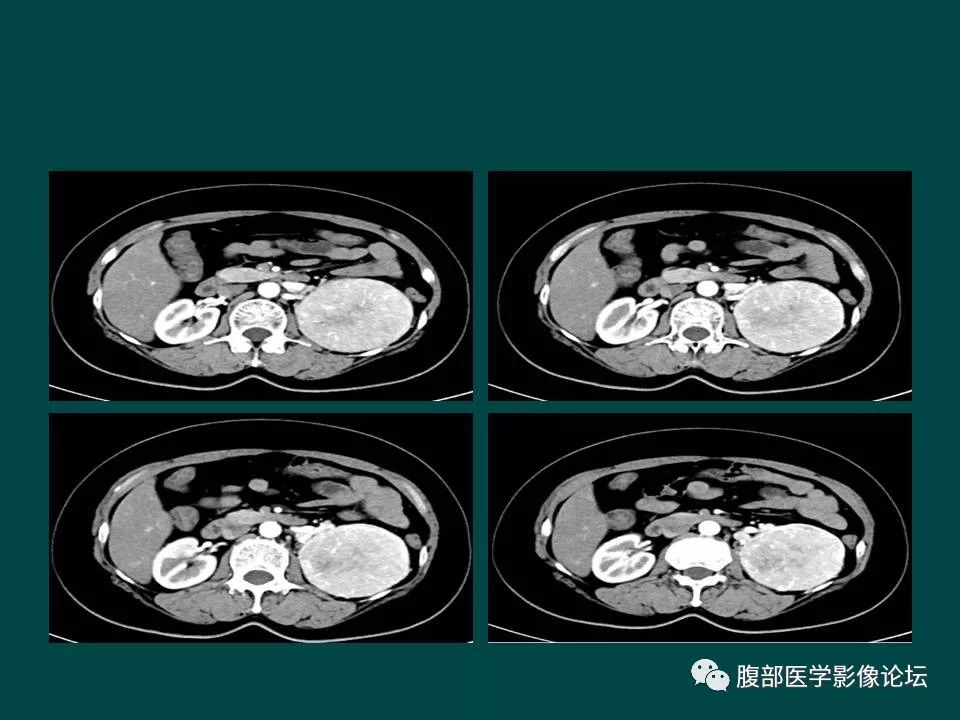 【病例】左肾嫌色细胞癌1例CT