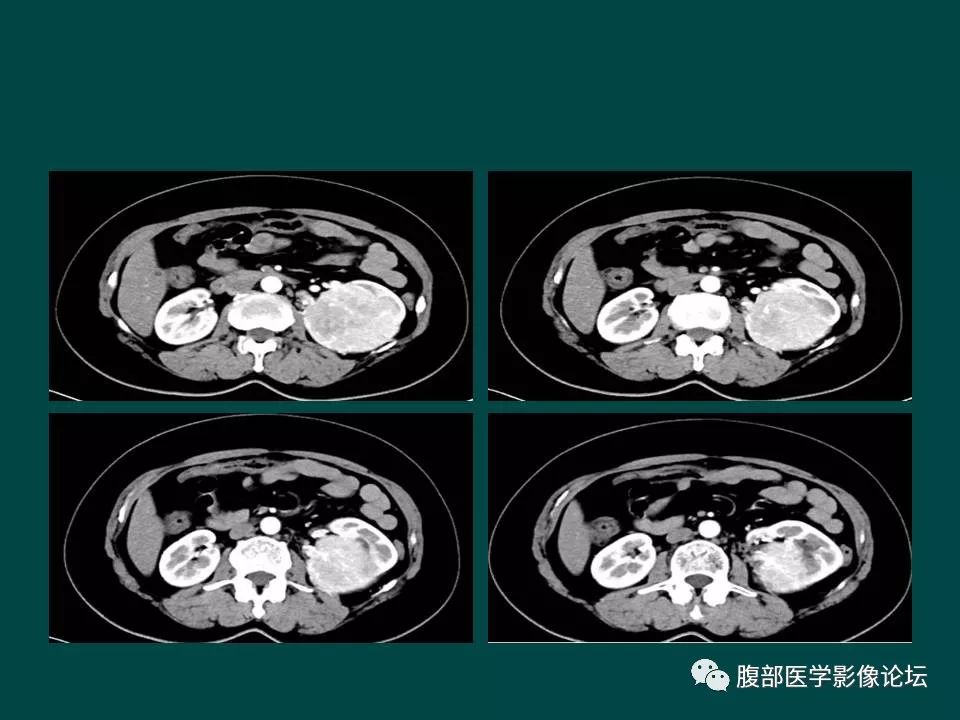【病例】左肾嫌色细胞癌1例CT