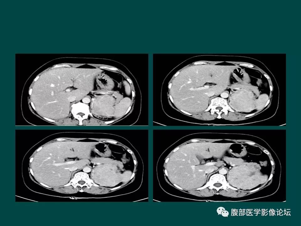 【病例】左肾嫌色细胞癌1例CT