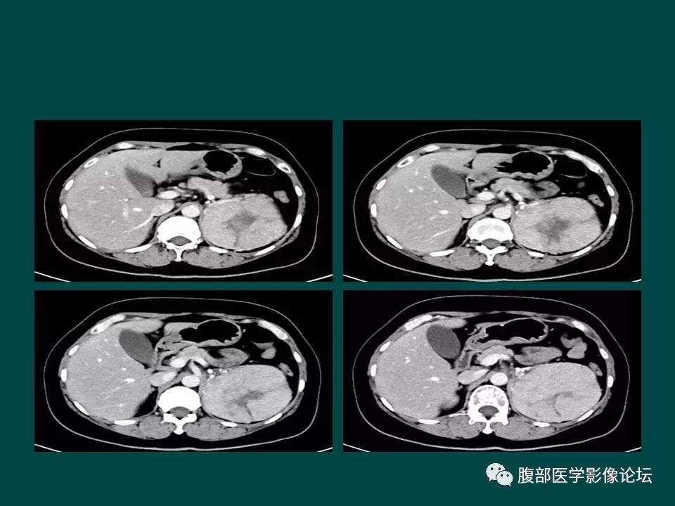 【病例】左肾嫌色细胞癌1例CT