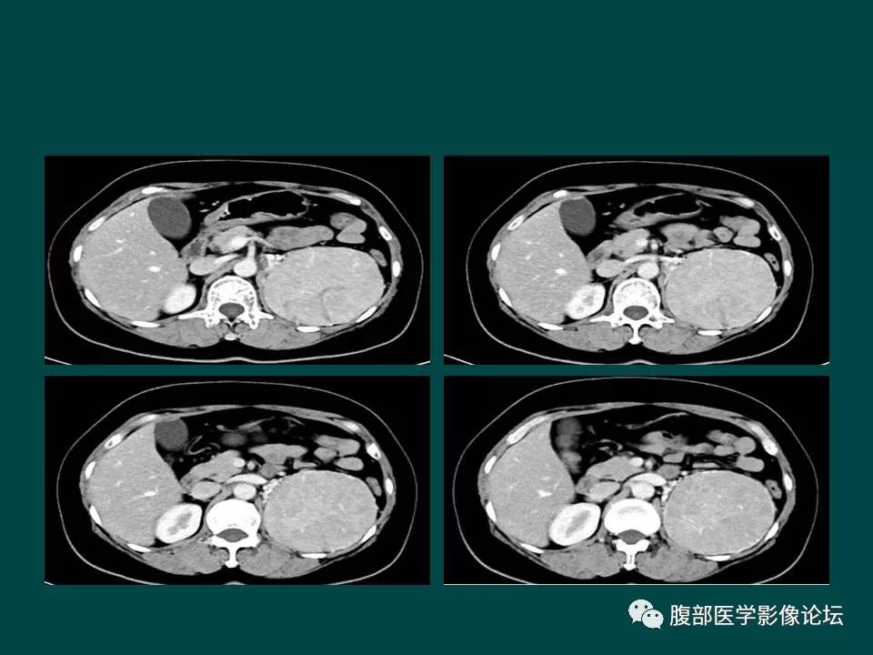 【病例】左肾嫌色细胞癌1例CT