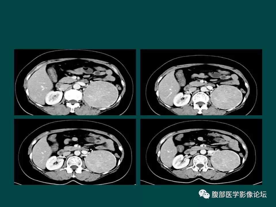 【病例】左肾嫌色细胞癌1例CT