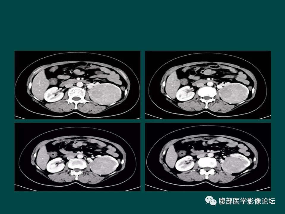 【病例】左肾嫌色细胞癌1例CT