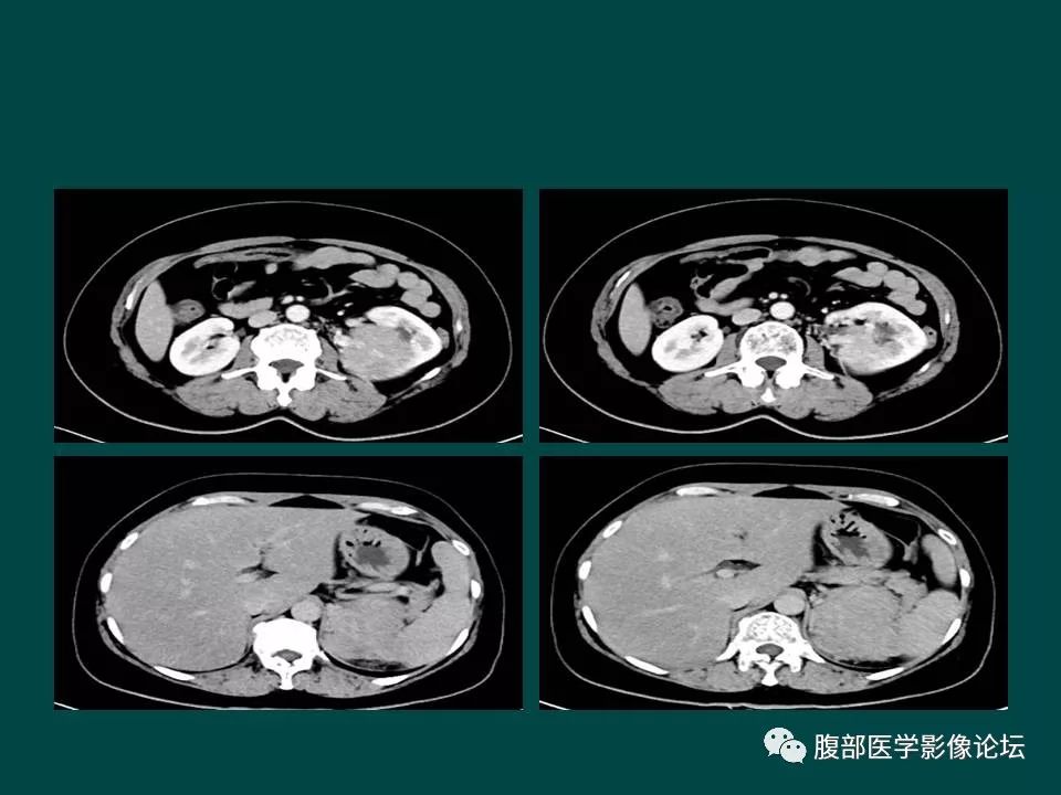 【病例】左肾嫌色细胞癌1例CT