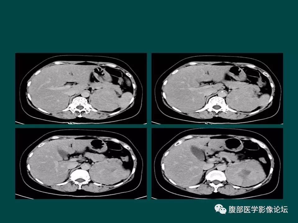 【病例】左肾嫌色细胞癌1例CT