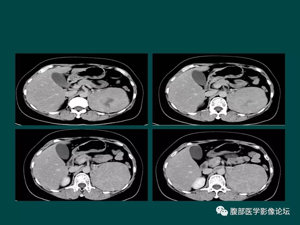 【病例】左肾嫌色细胞癌1例CT