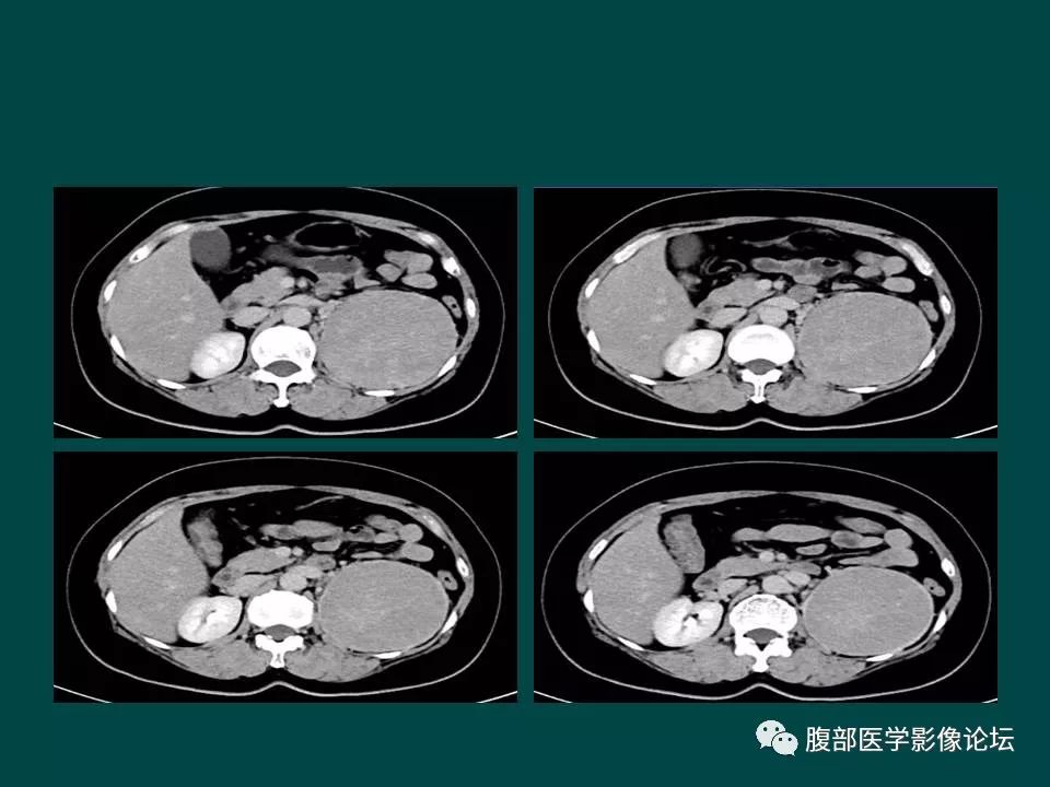 【病例】左肾嫌色细胞癌1例CT
