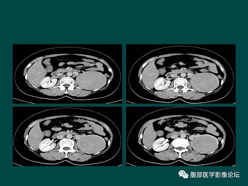 【病例】左肾嫌色细胞癌1例CT