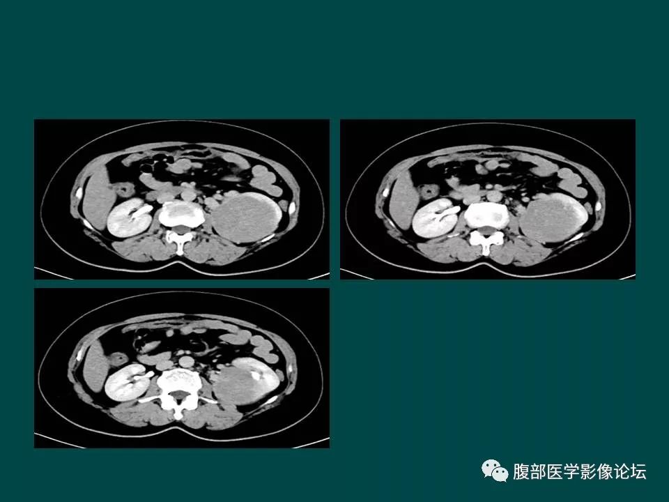 【病例】左肾嫌色细胞癌1例CT