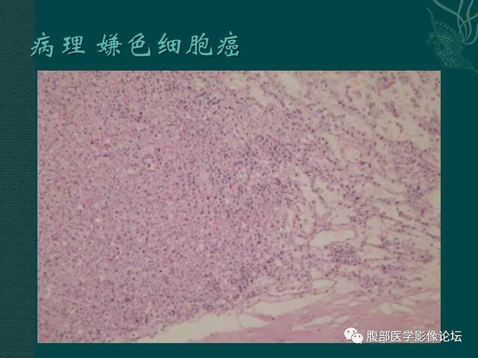 【病例】左肾嫌色细胞癌1例CT