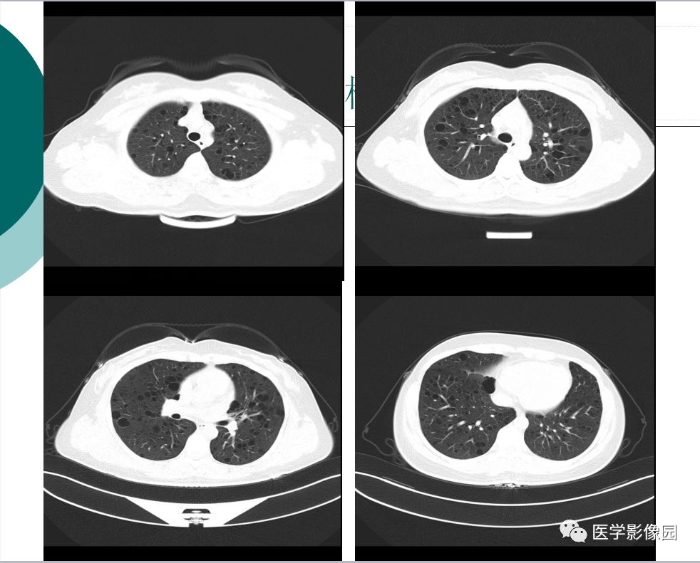 【病例】肺淋巴管肌瘤病1例CT