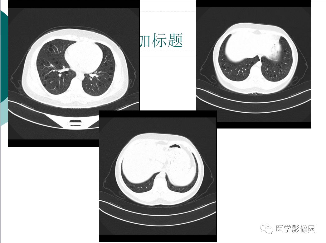 【病例】肺淋巴管肌瘤病1例CT