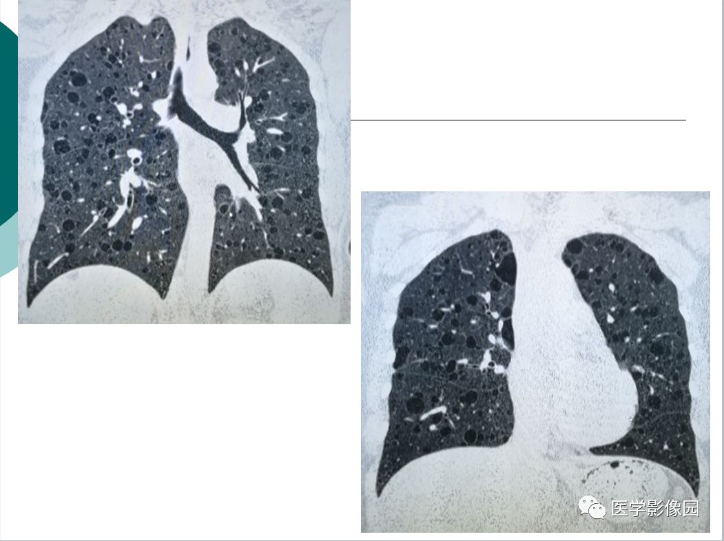 【病例】肺淋巴管肌瘤病1例CT