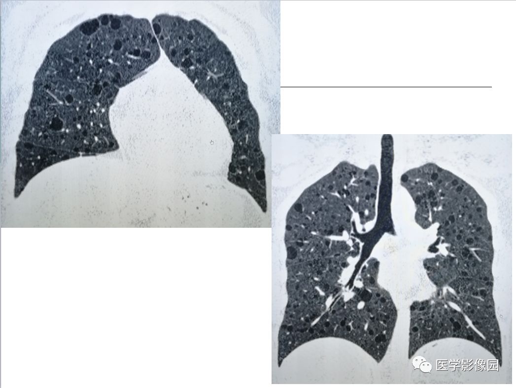 【病例】肺淋巴管肌瘤病1例CT