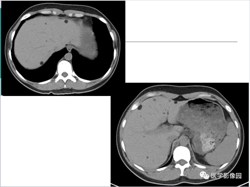 【病例】肺淋巴管肌瘤病1例CT