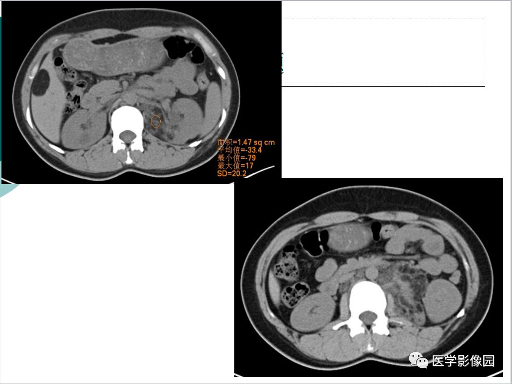 【病例】肺淋巴管肌瘤病1例CT