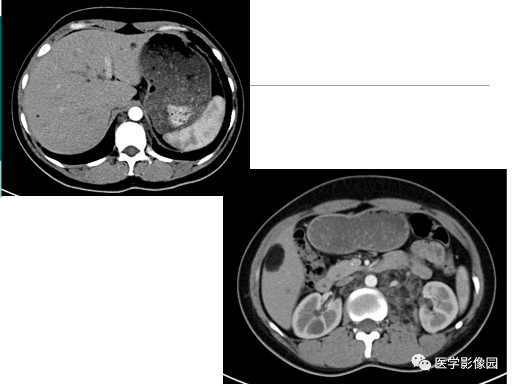 【病例】肺淋巴管肌瘤病1例CT