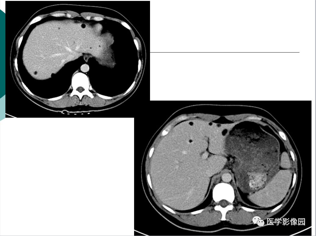【病例】肺淋巴管肌瘤病1例CT